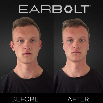 EARBOLT Ear-Pinning Adhesives | Otoplasty Alternative