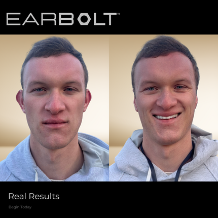 EARBOLT Ear-Pinning Adhesives | Otoplasty Alternative